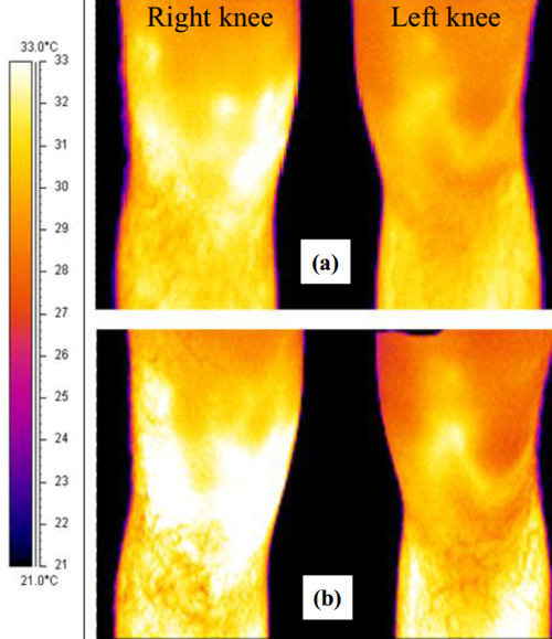 右膝OA運(yùn)動員比賽前后左右膝蓋的紅外熱成像